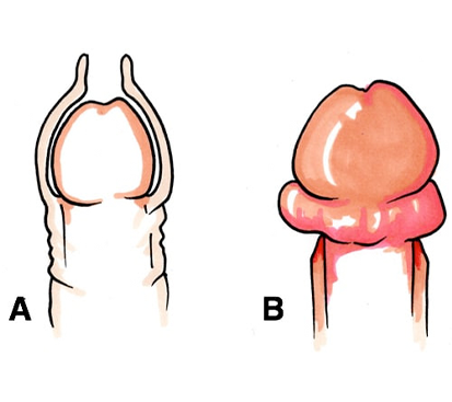 Swollen Penis Surgery in Mogappair